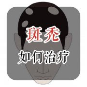 斑禿植發(fā)效果好嗎